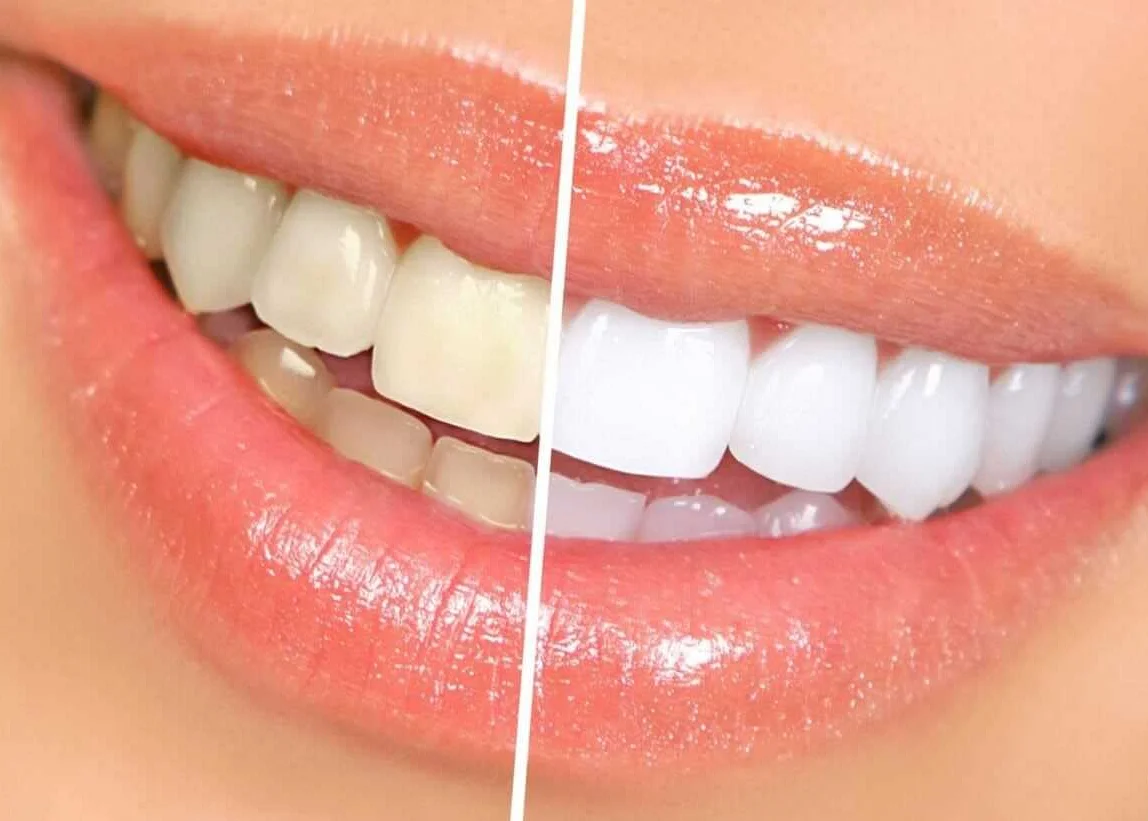 7 продуктов которые отбеливают зубы естественным способом