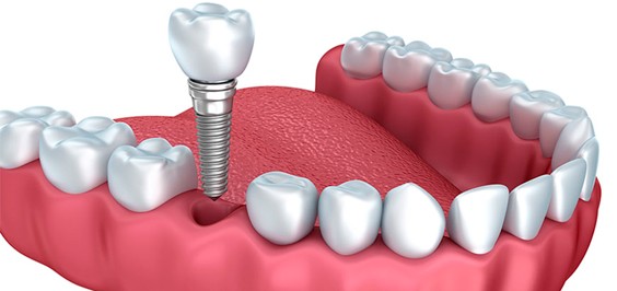 Имплантация зубов основные этапы их особенности и значение