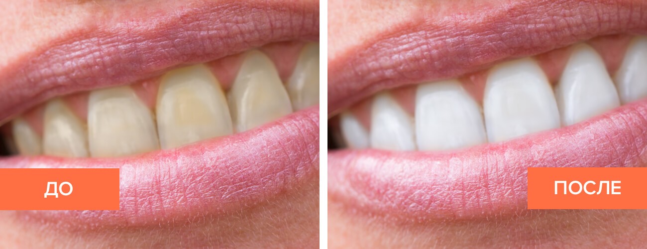 Рецепт эффективного отбеливания зубов простым активированным углем с фото до и после