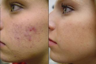 Карбоновый пилинг и его воздействие на кожу лица — фото до и после отзывы