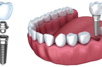 implantaciya zubov osnovnye etapy osobennosti i znachenie